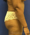 Tummy Tuck case #3968