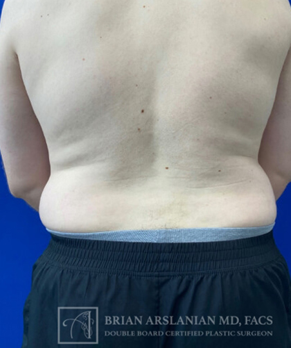 Liposuction case #3785