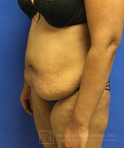 Tummy Tuck case #3968