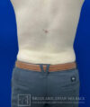 Liposuction case #3785