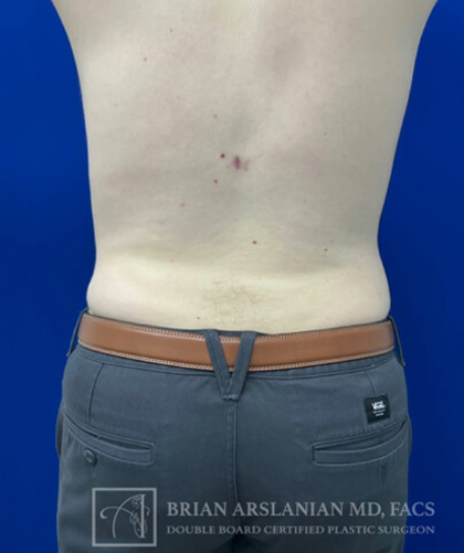 Liposuction case #3785