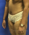 Tummy Tuck case #3968