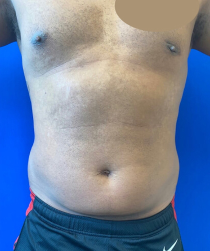 Liposuction case #3795