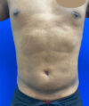 Liposuction case #3795