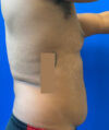 Liposuction case #3795