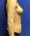 Fat Transfer to the Breasts - American Breast Lift™ ABL case #2432