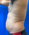 Liposuction case #3795