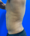 Liposuction case #3795