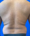 Liposuction case #3795