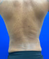 Liposuction case #3795