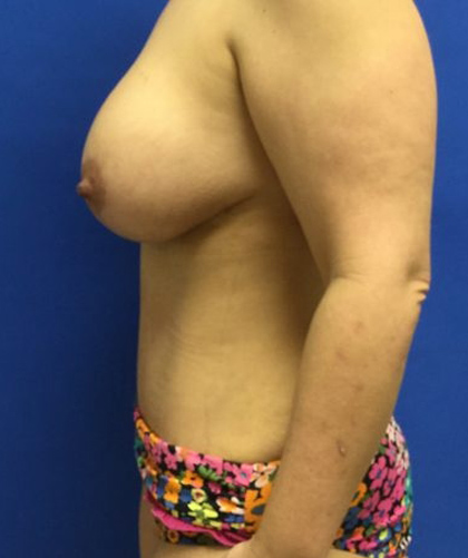 Tummy Tuck case #3980