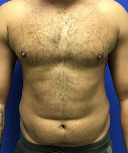 Liposuction case #3804