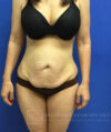 Tummy Tuck case #3991