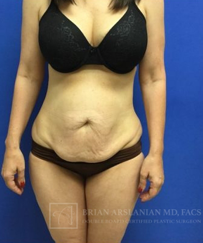 Tummy Tuck case #3991