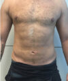 Liposuction case #3804