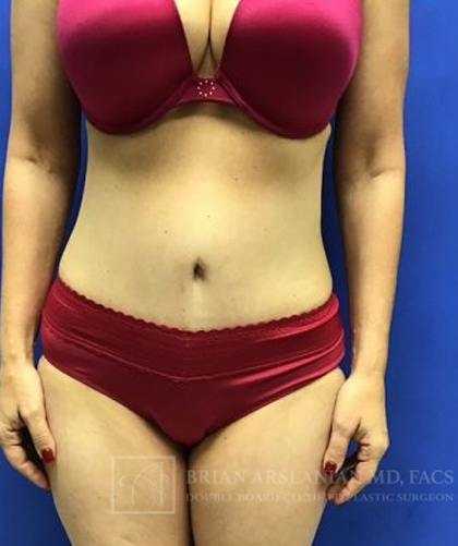 Tummy Tuck case #3991