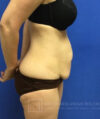 Tummy Tuck case #3991