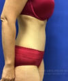 Tummy Tuck case #3991