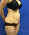 Tummy Tuck case #3991