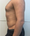 Liposuction case #3804