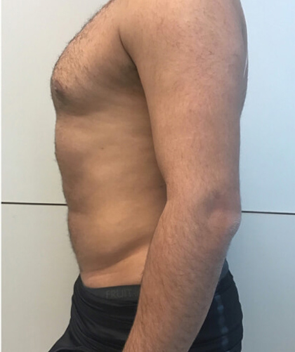 Liposuction case #3804