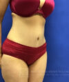 Tummy Tuck case #3991