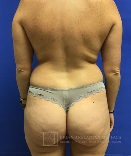 Brazilian Butt Lift case #2443