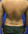 Liposuction case #3804