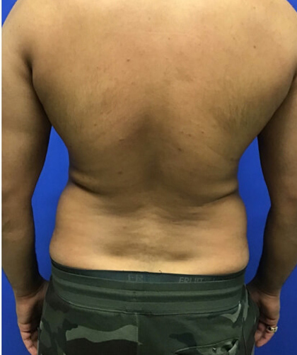 Liposuction case #3804