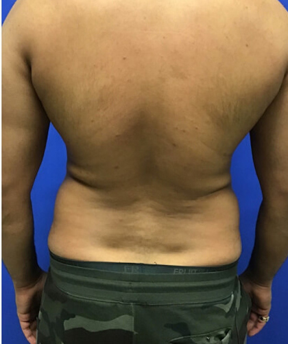 Liposuction case #3804