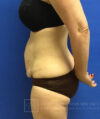 Tummy Tuck case #3991