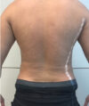 Liposuction case #3804