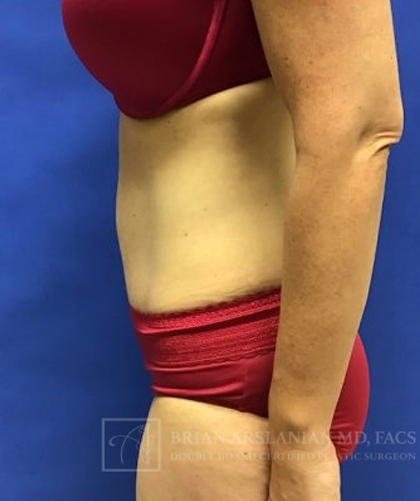 Tummy Tuck case #3991