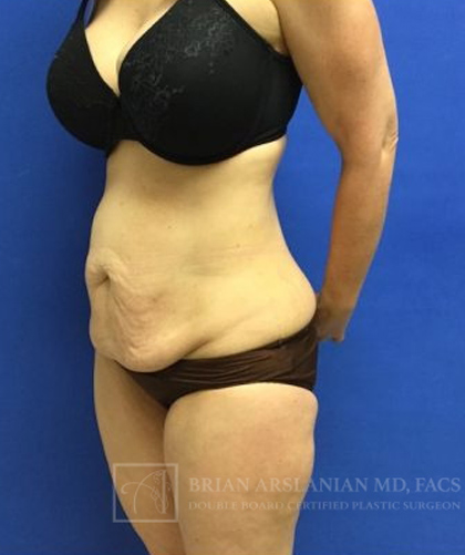 Tummy Tuck case #3991