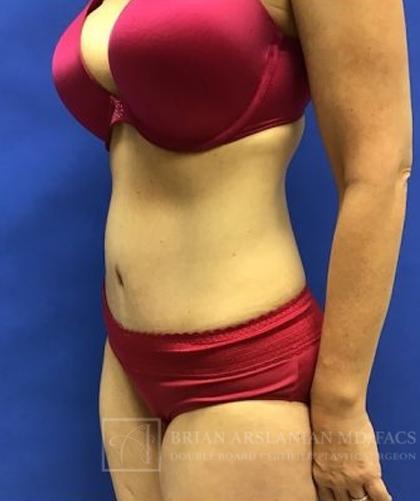 Tummy Tuck case #3991