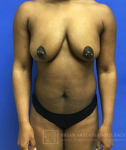 Fat Transfer to the Breasts - American Breast Lift™ ABL case #2452