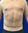 Liposuction case #3813