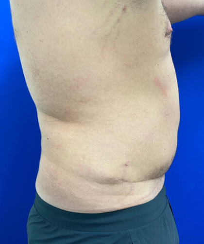 Liposuction case #3813