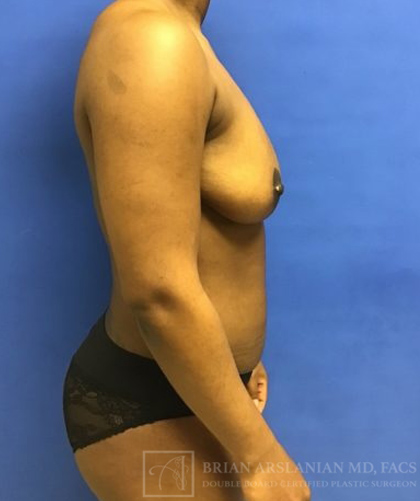 Fat Transfer to the Breasts - American Breast Lift™ ABL case #2452