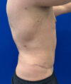 Liposuction case #3813