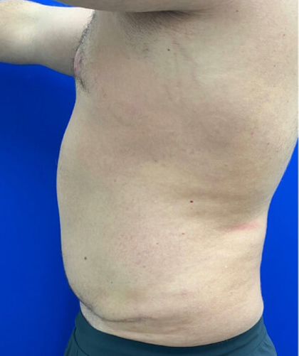 Liposuction case #3813