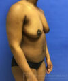 Fat Transfer to the Breasts - American Breast Lift™ ABL case #2452