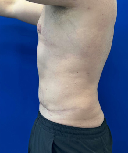 Liposuction case #3813