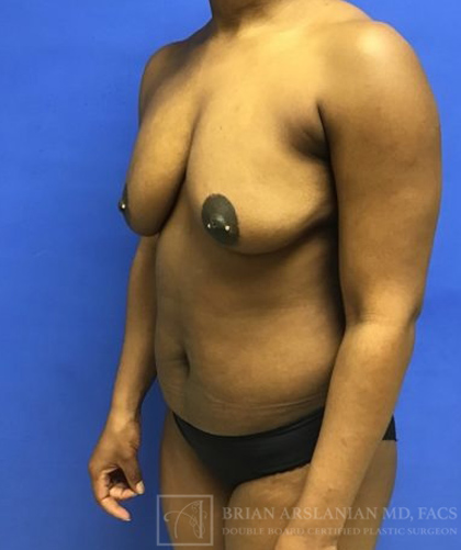 Fat Transfer to the Breasts - American Breast Lift™ ABL case #2452