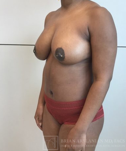 Fat Transfer to the Breasts - American Breast Lift™ ABL case #2452