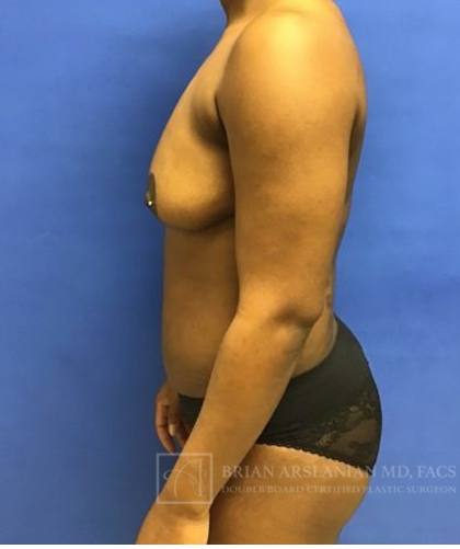 Fat Transfer to the Breasts - American Breast Lift™ ABL case #2452