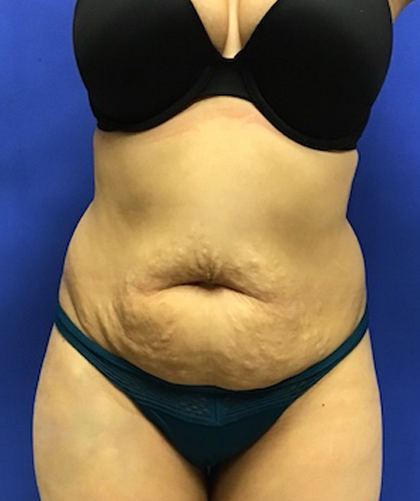 Tummy Tuck case #4003