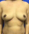 Fat Transfer to the Breasts - American Breast Lift™ ABL case #2463