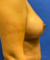Fat Transfer to the Breasts - American Breast Lift™ ABL case #2463