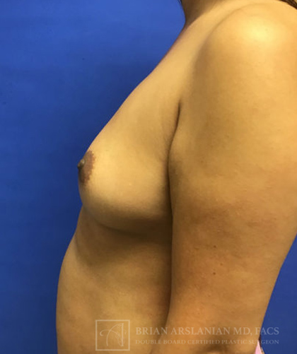 Fat Transfer to the Breasts - American Breast Lift™ ABL case #2463